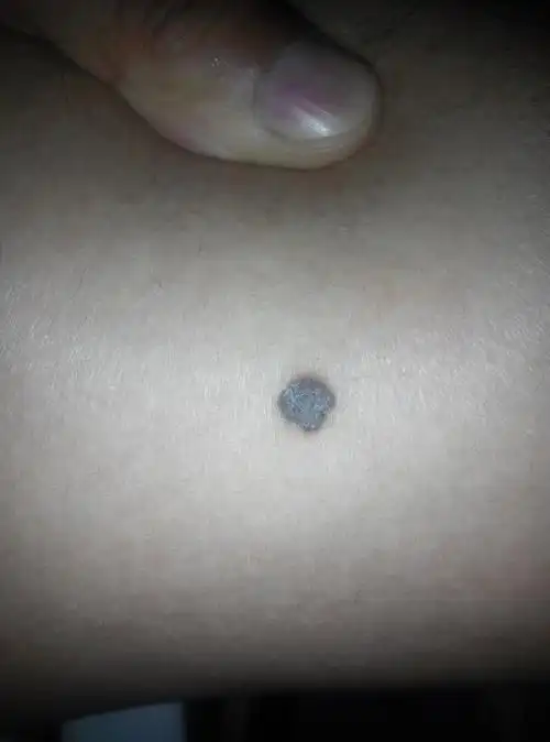 大夫您好我大腿内侧有个痣长了78年了有时一扣能把表面一