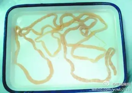 出国吃带血丝牛排后拉出25米绦虫