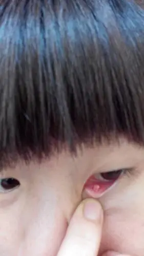 眼睛里长了这个东西这是什么东西啊我要不要去看啊