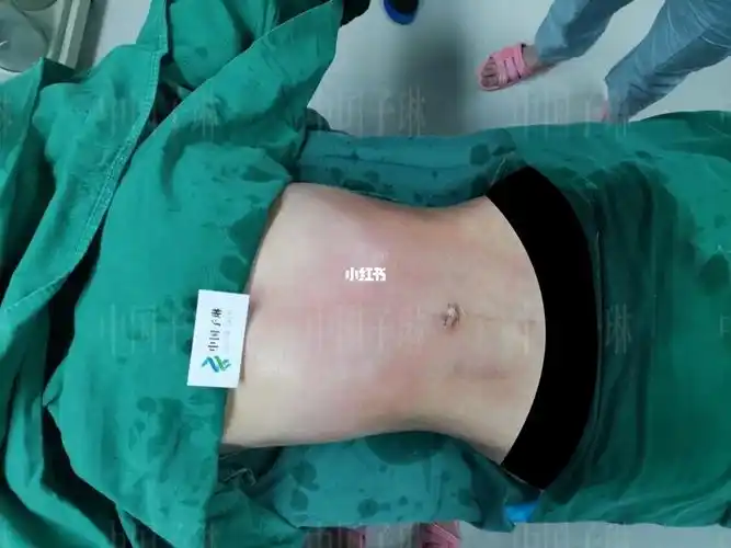 仅需一台威塑腰腹环吸手术