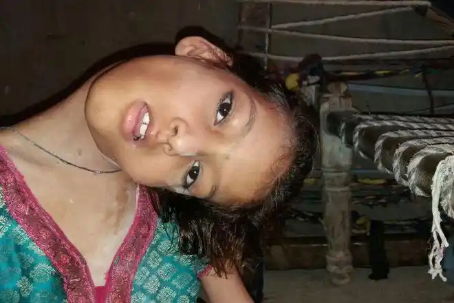 医疗落后导致残疾印度女孩摔跤后脖子变歪