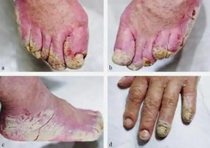 孕妇疥疮初期腹部皮肤症状图片