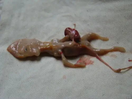 天我科有一年轻的妇女因为死胎住院引产,引出的胎儿类似干尸样有胎儿