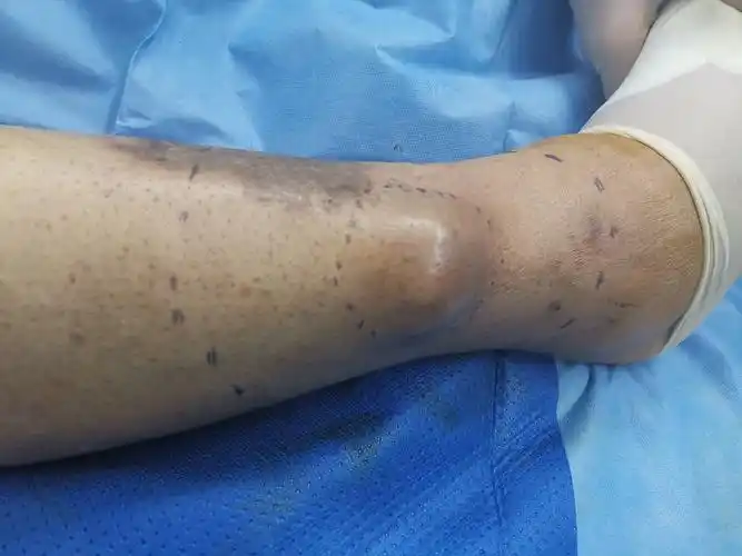 小腿恶性肿瘤规范治疗 - 好大夫在线