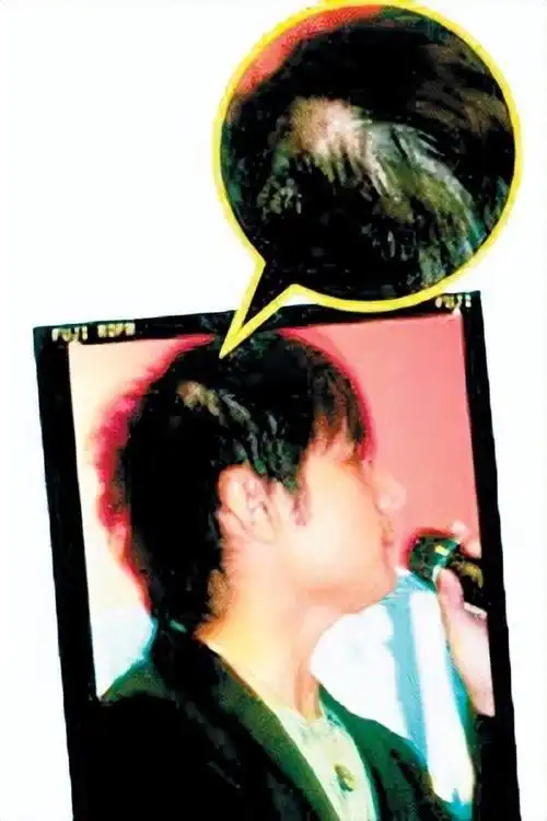 原来男星早就秃了黄晓明周杰伦头顶稀疏观众被骗惨了