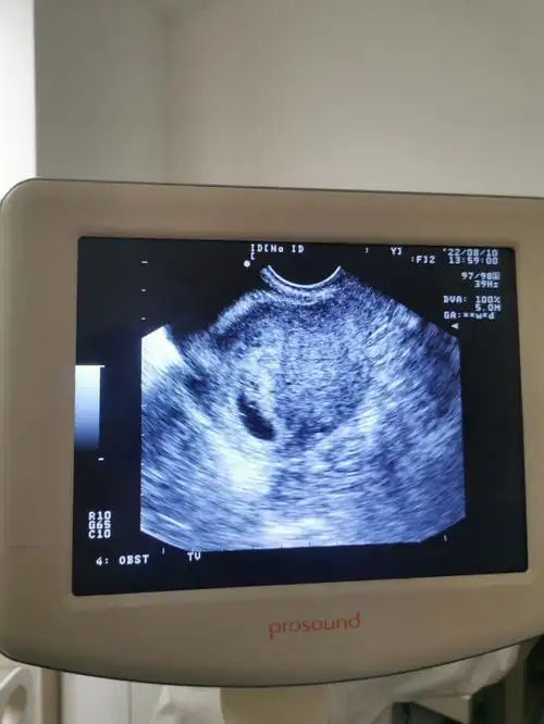 移植后第34天胎心胎芽可见