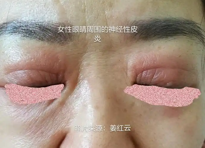 女性,眼睛周围神经性皮炎: - 好大夫在线