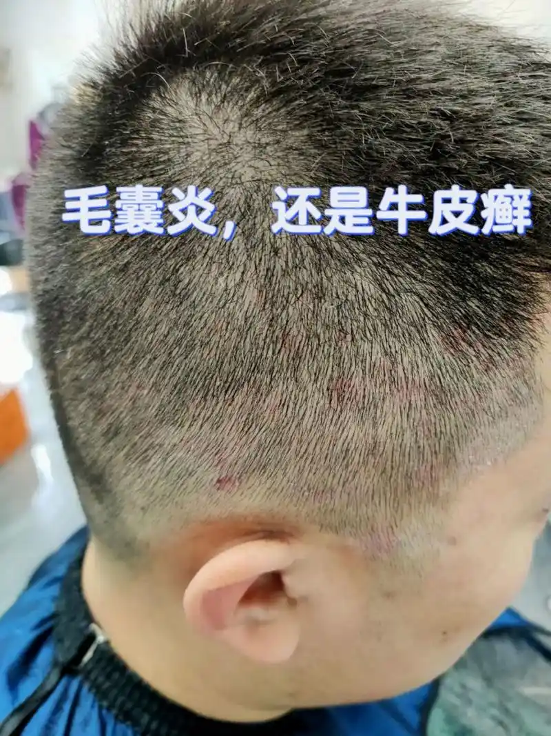 这顾客头发上有很多小疙瘩,特别痒,种用手去抓,头皮很多地方都被抓破