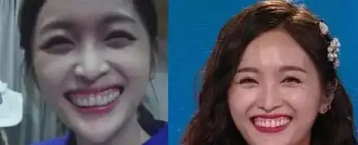 迪丽热巴走过最错误的路就是整牙,烤瓷牙真是毁容一大利器