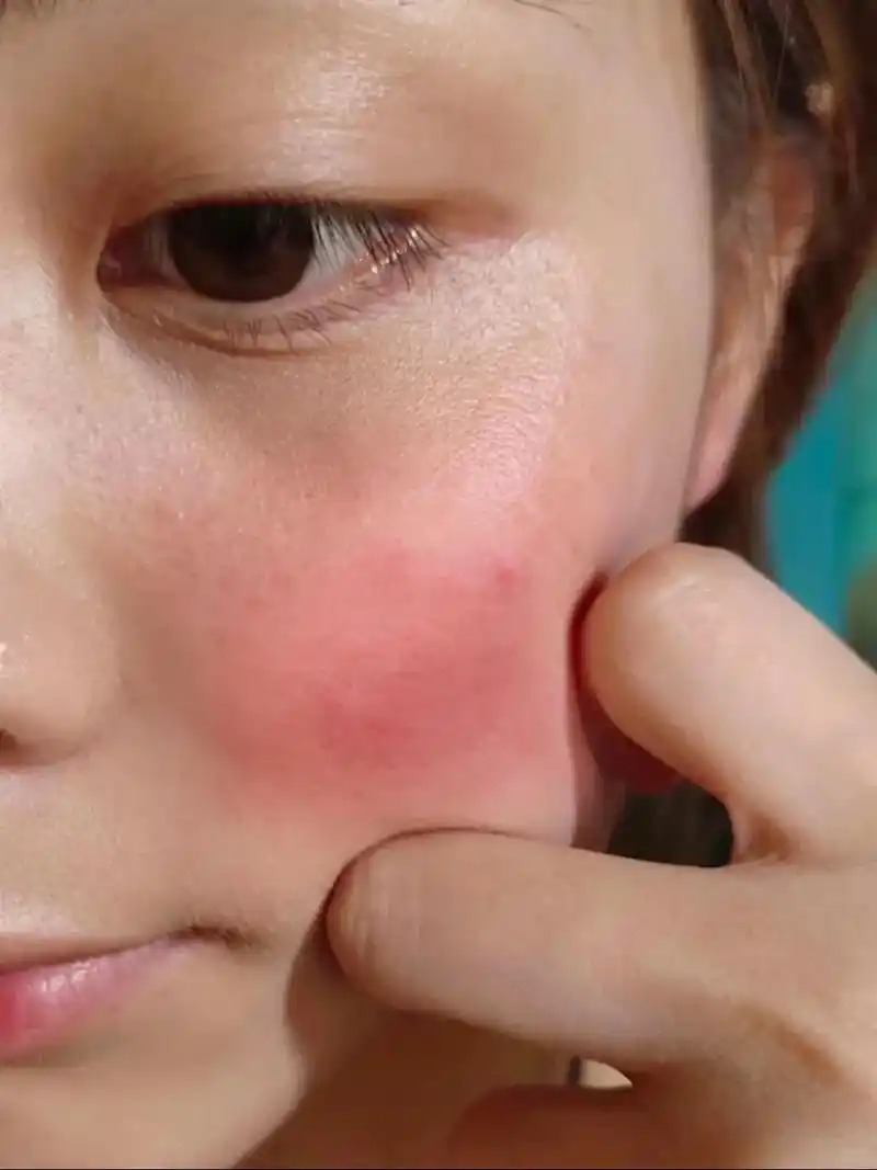 才知道过敏脸修复原来这么简单!