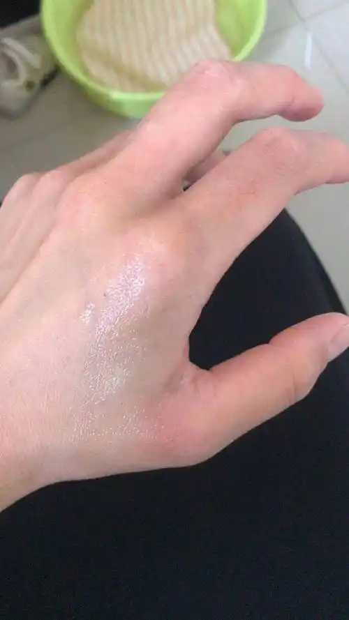 开水烫伤正确的处理方法.不起泡,不红肿.看到请收藏