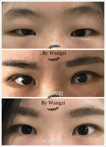 "炯目术"(提肌手术)术前,术后对比照
