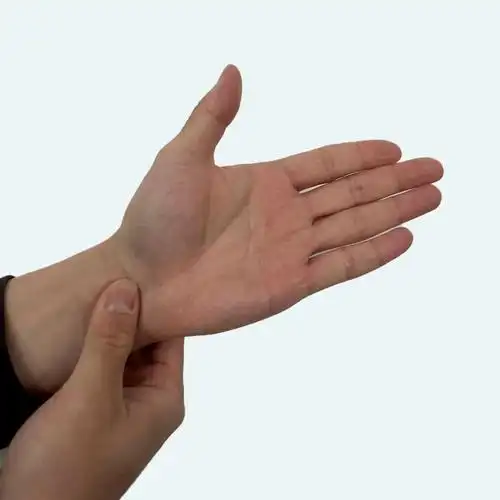 随着病情加重,可出现明确的手指感觉减退或消失,拇短展肌和拇对掌肌