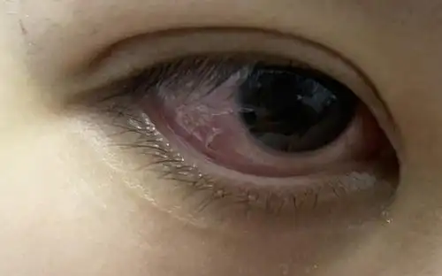 有没有和我出现过一样的情况的姐妹啊,突然眼睛就布满红血丝了,应该没