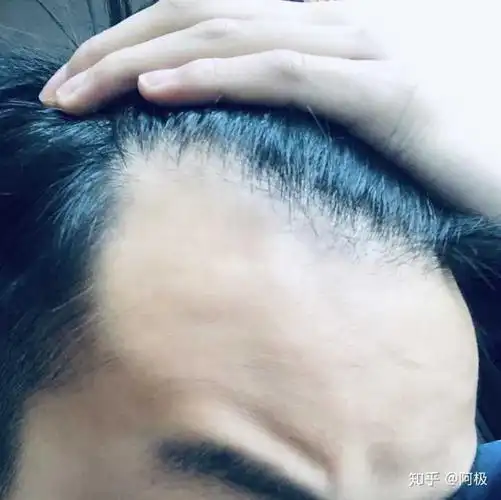 20多岁的男生有一个m型发际线是怎样的体验?