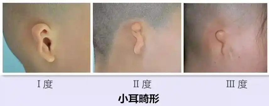 为什么会出现小耳畸形?