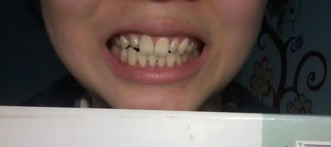 牙齿长歪成这样了还能不能矫正?我今年18岁