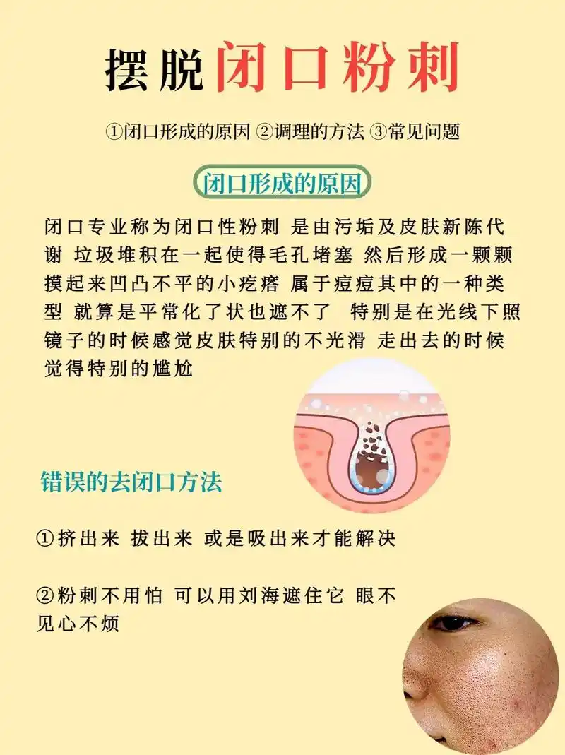 脸上闭口反反复复7515如何从根源上处理闭口.