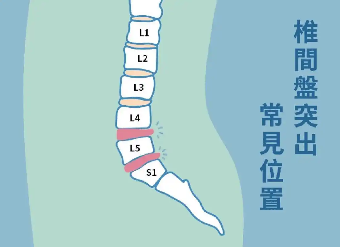 我们人体有5个腰椎,椎体与椎体之间有一个柔软而富有弹性的组织,臼乔