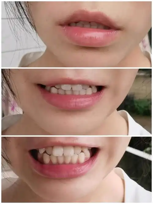 求助|20岁去整牙晚吗,这口龅牙还有救吗