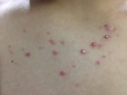 最近胸前起了一片这种疙瘩,挤感觉很疼,挤的话大疙