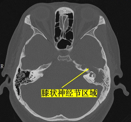 面神经瘤的影像学特点