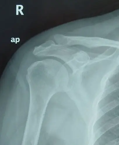 肩关节内肌腱钙化是怎么回事_肩周炎_肩周炎治疗方法 - 好大夫在线