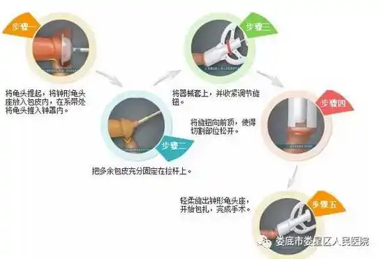 器内,用机械力量阻断阴茎皮肤血液循环,使需要切除的包皮干性坏死脱落