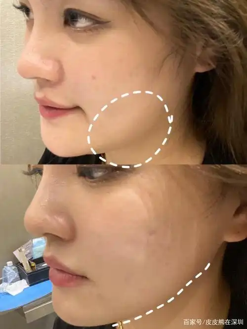 发腮到底是什么?我拿什么来拯救你的大脸!