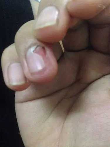 指甲能张回来吗