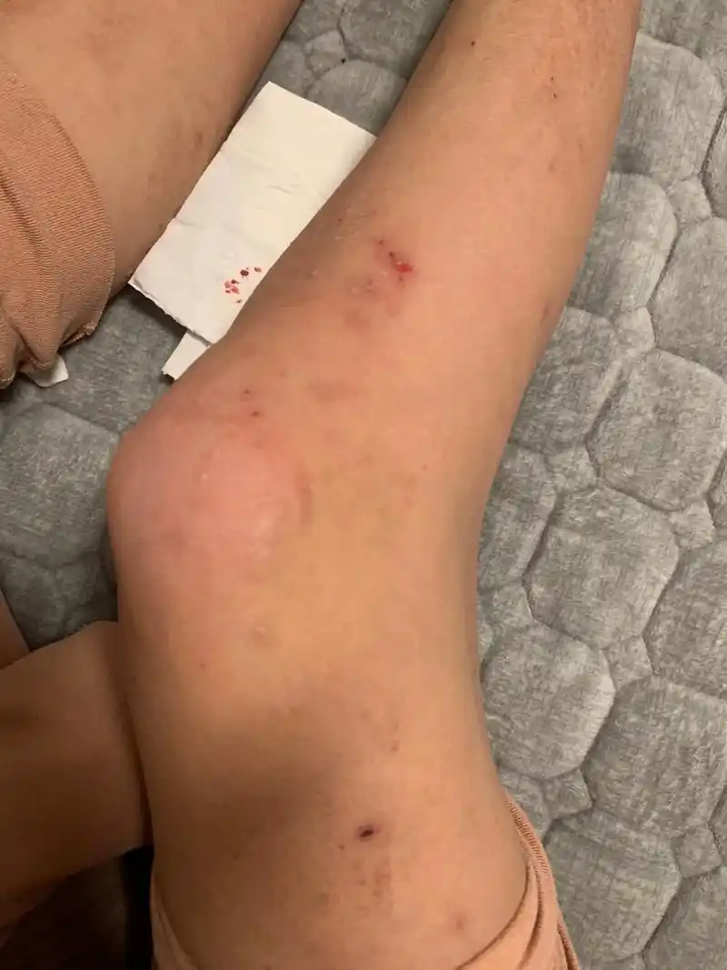 皮肤病,糖尿病整的我没法了.这是什么腿啊?什么皮肤啊?每天折 - 抖音