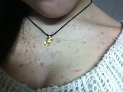 这个痘痘不痛也不痒, 没其他症状, 请问是个是毛囊炎,同问