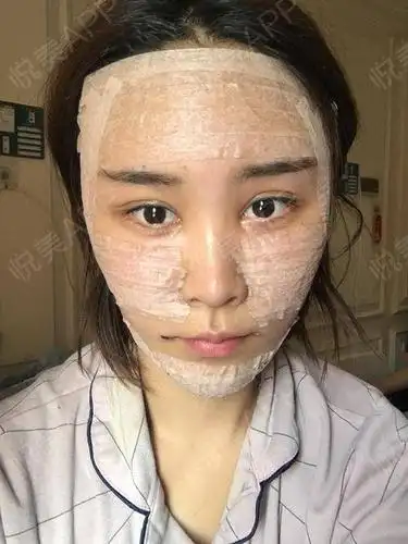 自体脂肪面部填充术后2天_面部填充术后2天_自体脂肪术后2天_面部轮廓