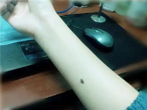 右手臂内侧有痣的代表会遇见前世的爱吗