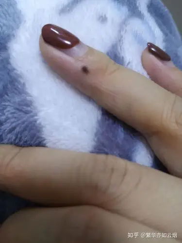 手指上长痣,并且越来越大,这是怎么回事? - 知乎