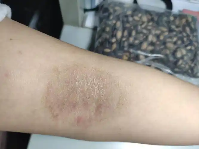 神经性皮炎怎么办求解啊