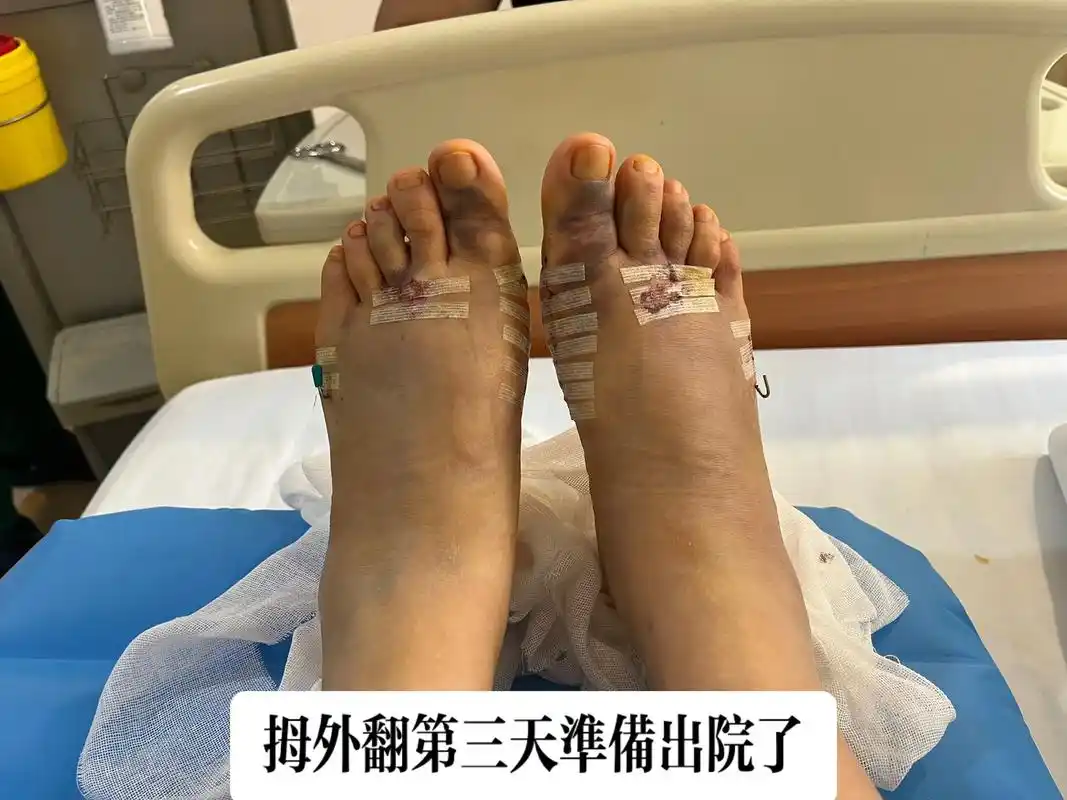 拇外翻手术第三天.