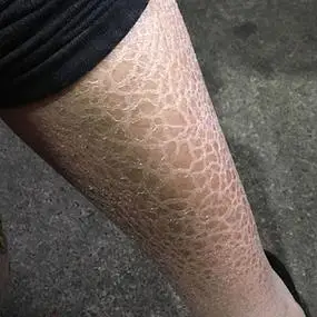 蛇皮肤鱼鳞皮肤手臂小腿胳膊干燥起皮毛周角化修复霜脱皮去鱼鳞治