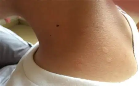 中山医生有关花斑癣给出以下小提示