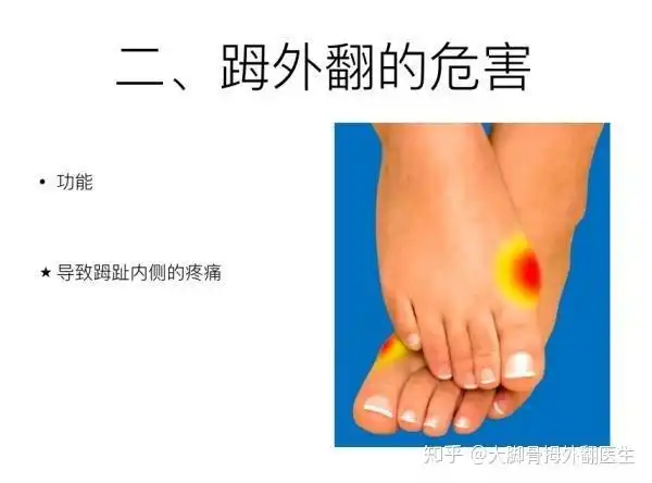 拇外翻是什么有什么危害大脚骨的最佳治疗方法是什么