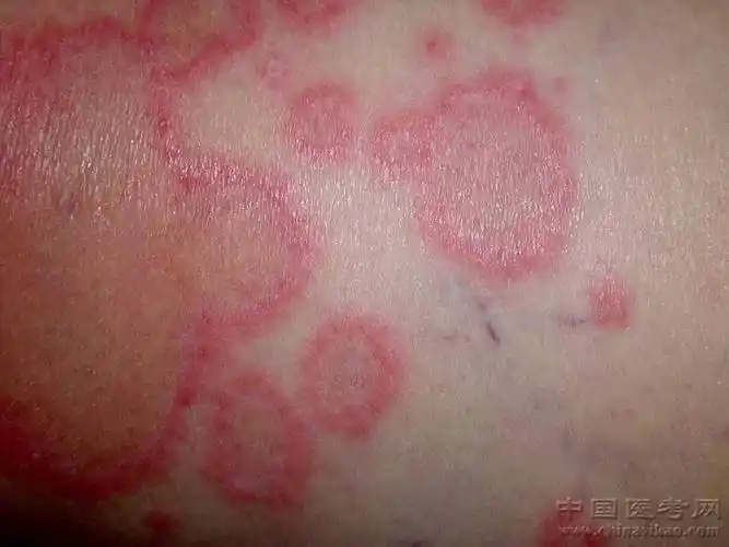 史上最全的皮肤病图谱来了(修订版)!