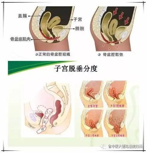 合成补片行阴道骶骨固定术作为治疗阴道顶端缺陷,穹窿脱垂的主要术式