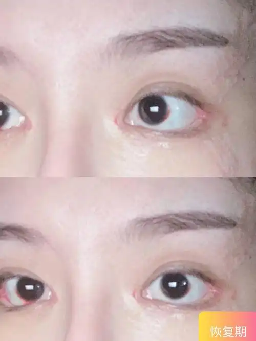 眼睑下至# 拆线了 开始了贴胶布大法 希望后眼角_圈子-新氧美容整形