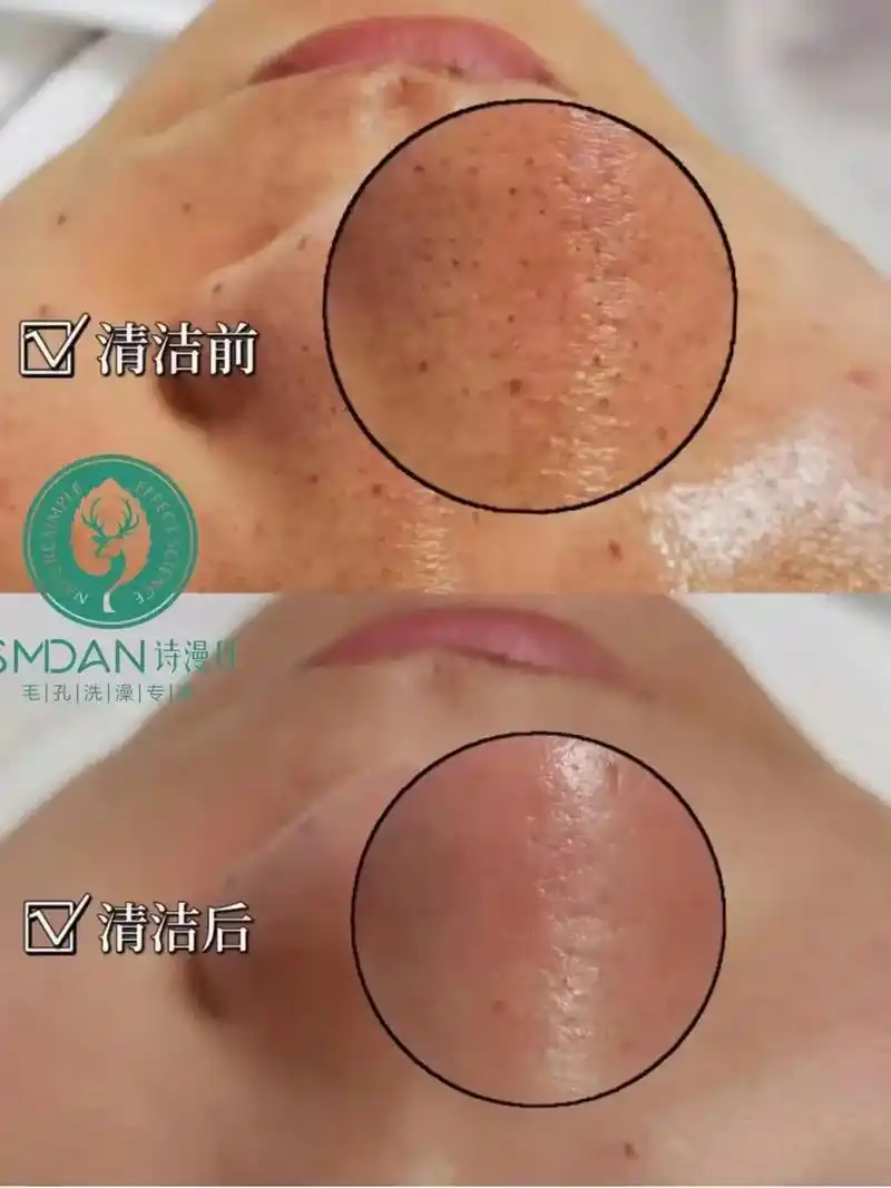 91 毛孔粗大草莓鼻长期得不 - 抖音