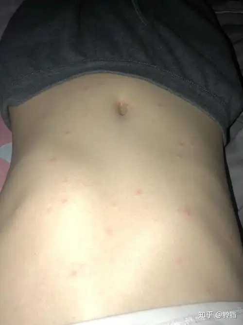 不堪回首的成人水痘