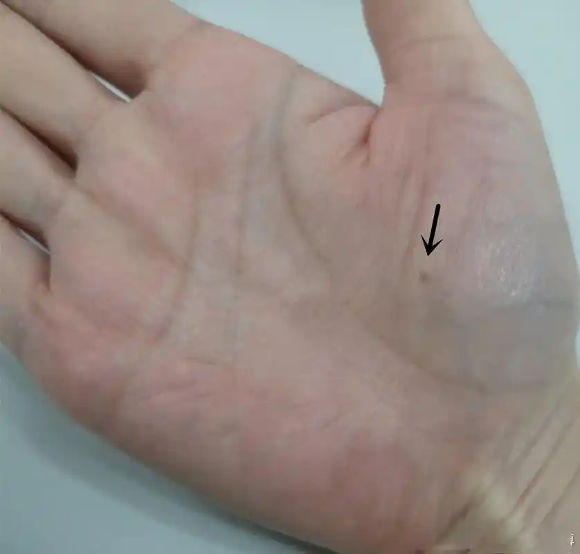 金星丘有痣,说明具有同情心,审美观很好,而且自身的桃花运也比较旺盛