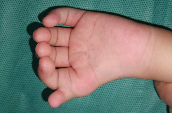 漂浮拇:成功保五指 | 案例6《小女孩患先天性特殊型漂浮拇,历经两次