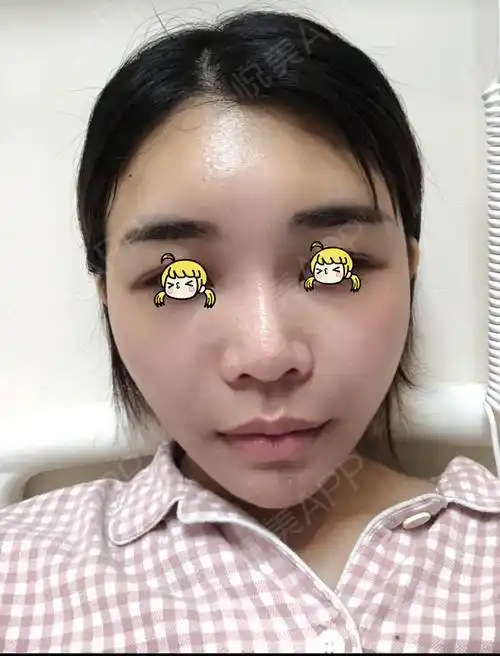 自体脂肪面部填充术后4天_自体脂肪丰下巴术后4天_面部填充术后4天_垫