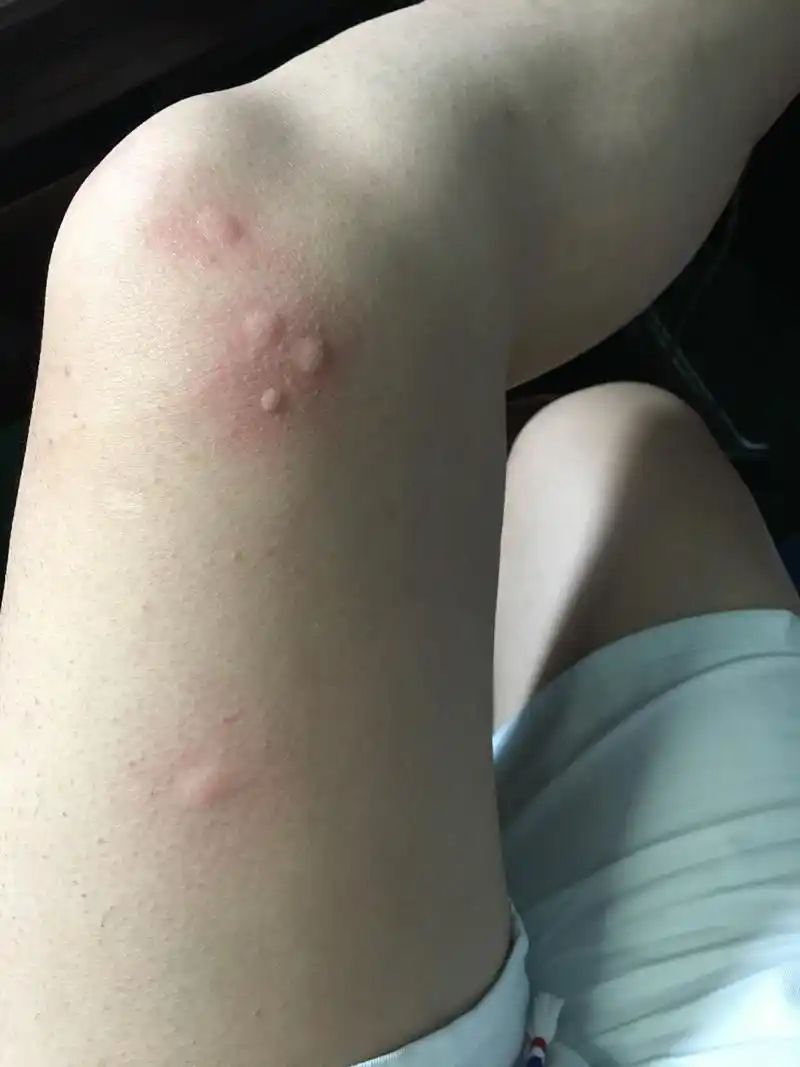 才刚上班一会就被蚊子咬的全是包