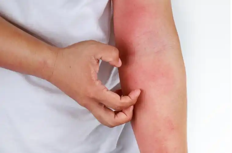 65 岁老人瘙痒难忍,全身血印惨不忍睹!皮肤痒得受不了,教你 5 招搞定!